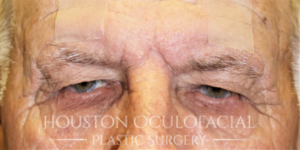 Upper Eyelid Blepharoplasty