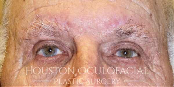 Upper Eyelid Blepharoplasty