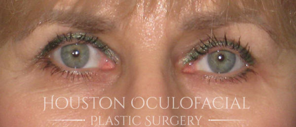 Upper Eyelid Blepharoplasty