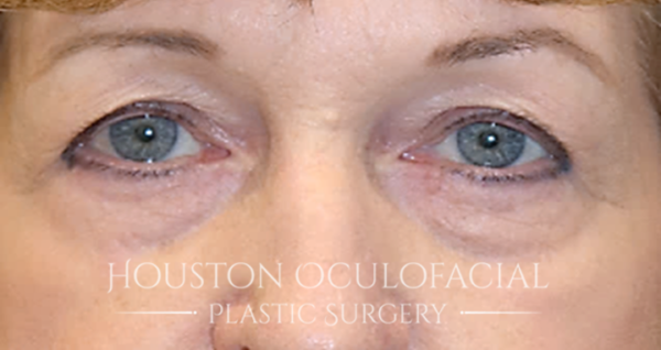 Upper Eyelid Blepharoplasty