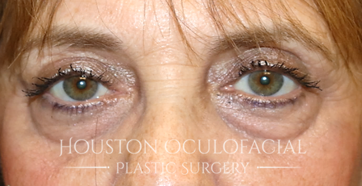 Upper Eyelid Blepharoplasty