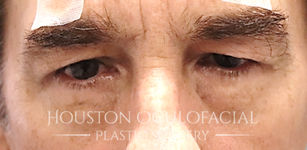 Upper Eyelid Blepharoplasty Case 5188 Before Photo Upper Eyelid Blepharoplasty