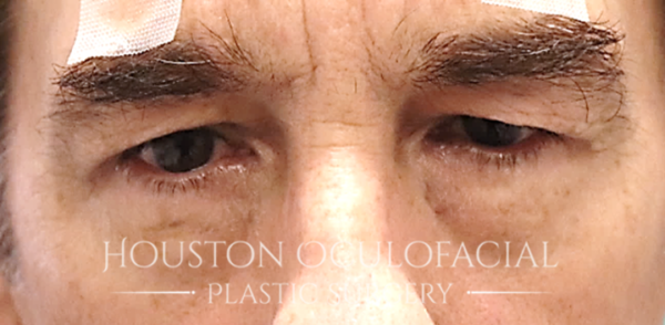 Upper Eyelid Blepharoplasty