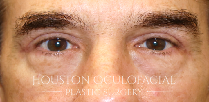 Upper Eyelid Blepharoplasty