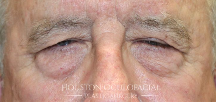 Upper Eyelid Blepharoplasty