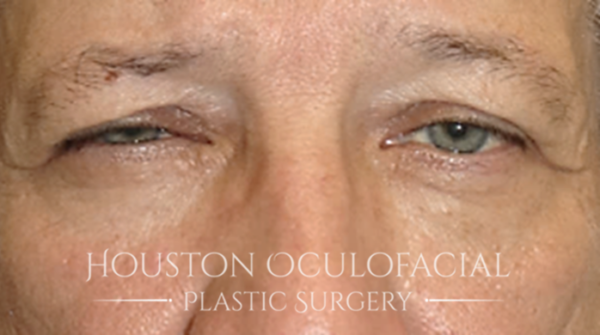 Upper Eyelid Blepharoplasty