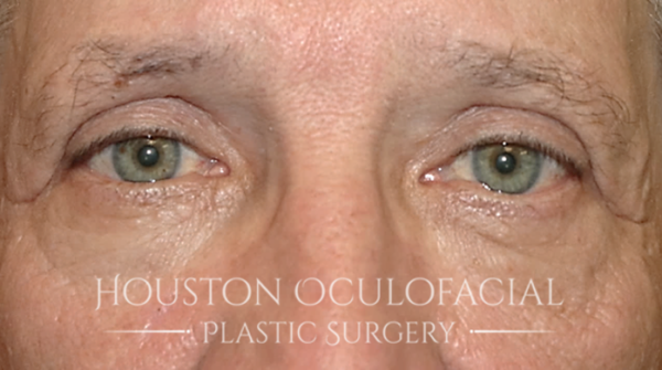 Upper Eyelid Blepharoplasty