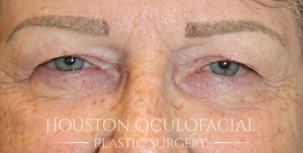 Upper Eyelid Blepharoplasty