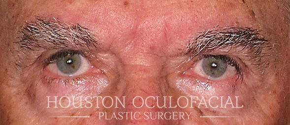 What can I Expect from Blepharoplasty