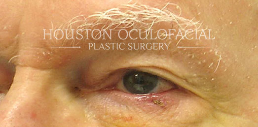 Eyelid Skin Cancer - Before Houston
