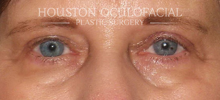 Ptosis Blepharoplasty - After