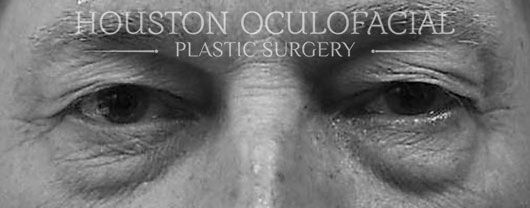 Lower Lid Blepharoplasty - Before