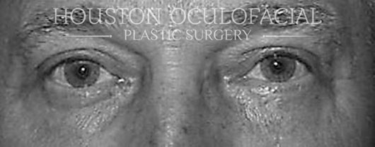 Lower Lid Blepharoplasty - After