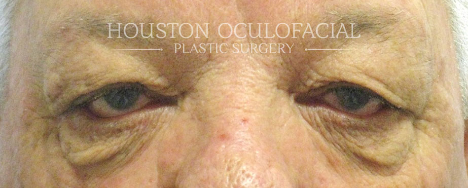 Cosmetic Upper Lid Blepharoplasty Surgery Results Houston