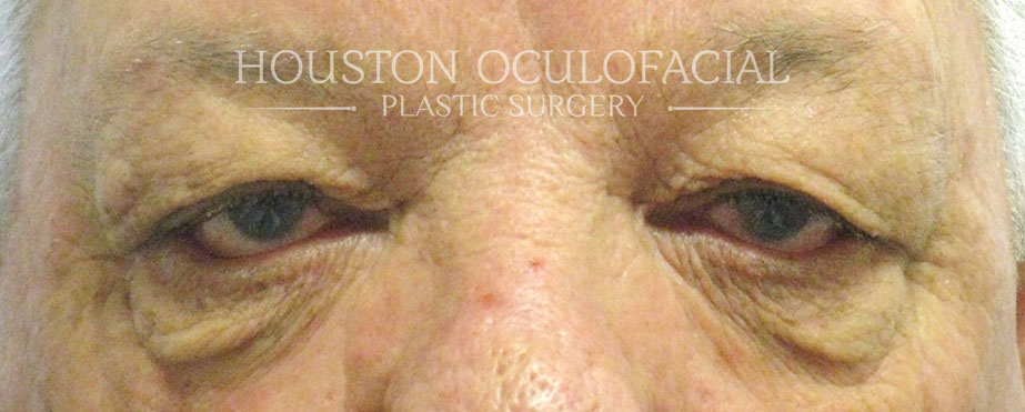 Upper Lid Blepharoplasty - Before