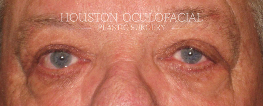 Cosmetic Upper Lid Blepharoplasty Surgery Results Houston