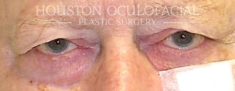 Eyelid Skin Cancer - Before Houston