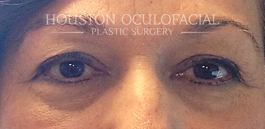 Cosmetic Blepharoplasty Surgery Results Houston
