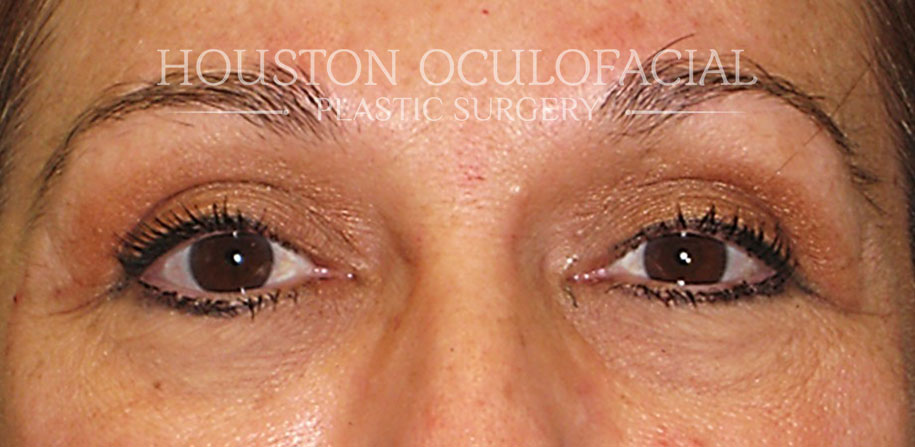 Lower Lid Blepharoplasty - After