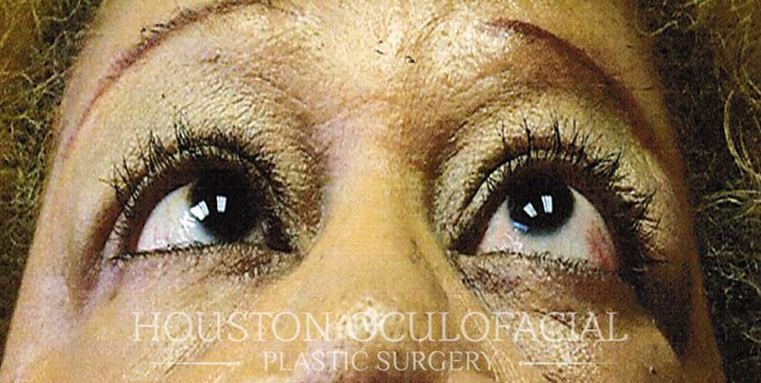 Thyroid Eye Disease - Before