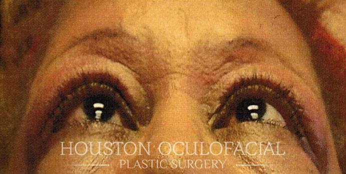 Thyroid Eye Disease - After