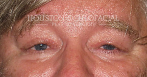 Ptosis before image