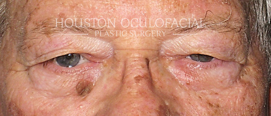 Blepharoplasty (Eyelid Lift) - Before