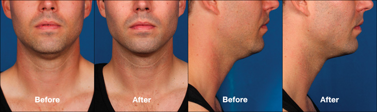 Kybella® before and after photos.