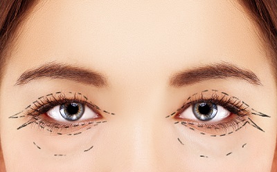 Blepharoplasty Procedure