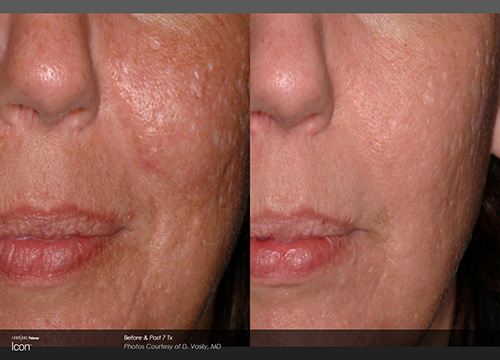 Skin Renewal, Scar Removal, and Stretch Mark Treatment Results Houston