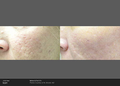 Skin Renewal, Scar Removal, and Stretch Mark Treatment Results Houston