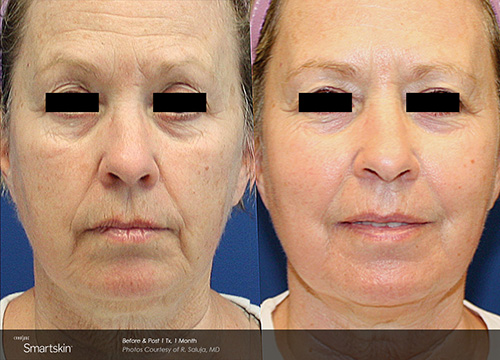 CO2 Laser Skin Resurfacing Results Houston