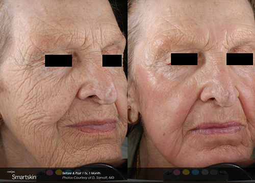 Fully Ablative CO2 Laser Resurfacing Treatment