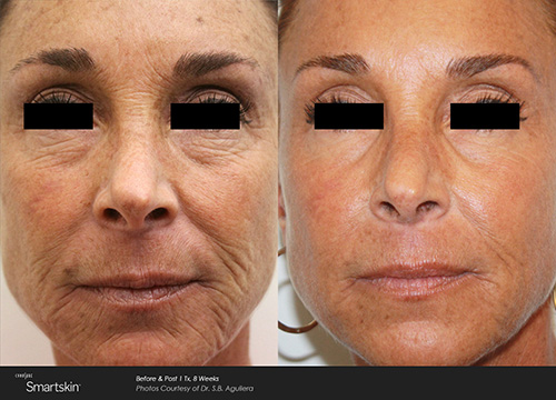 CO2 Laser Skin Resurfacing Results Houston