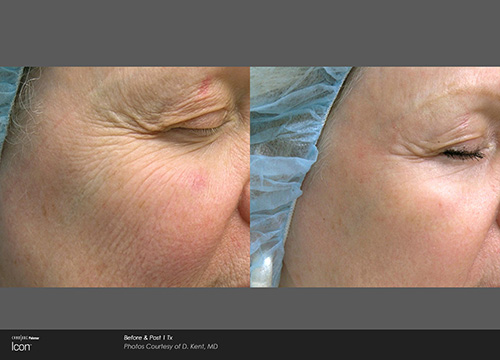 Skin Renewal, Scar Removal, and Stretch Mark Treatment Results Houston