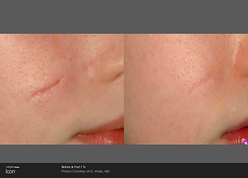 Skin Renewal, Scar Removal, and Stretch Mark Treatment Results Houston