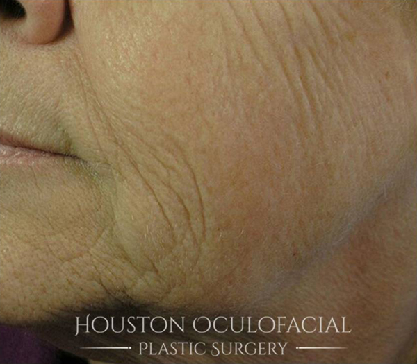 CO2 Laser Skin Resurfacing Results Houston