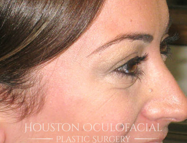 Botox Results Houston