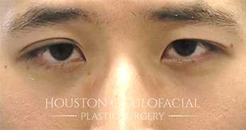 Asian Eyelid Surgery - Before Houston
