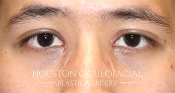 Asian Eyelid Surgery - After Houston