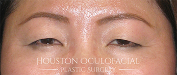 Asian Eyelid Surgery - Before Houston