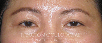 Asian Eyelid Surgery - After Houston