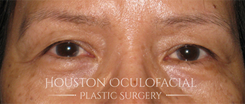 Asian Eyelid Surgery - Before