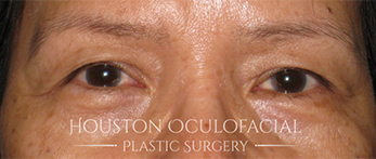 Asian Eyelid Surgery - Before Houston