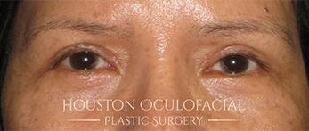 Asian Eyelid Surgery - After Houston