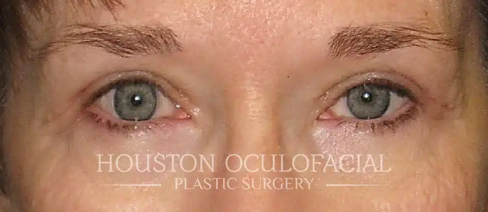 Upper Lid Blepharoplasty - After