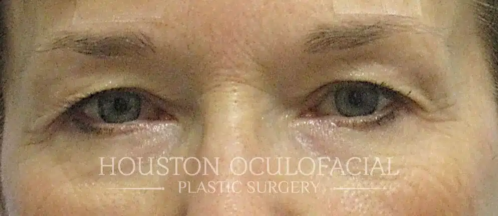 Upper Lid Blepharoplasty - Before